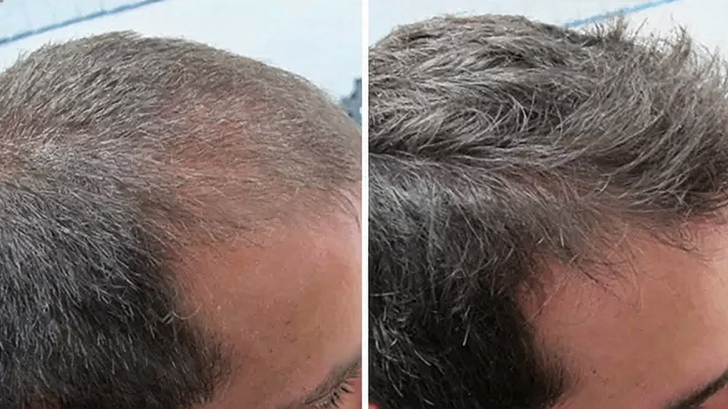 Before and after hair-loss progress for James L