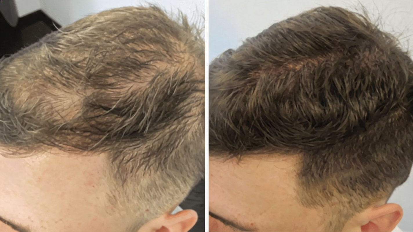 Before and after hair-loss progress for Michael T