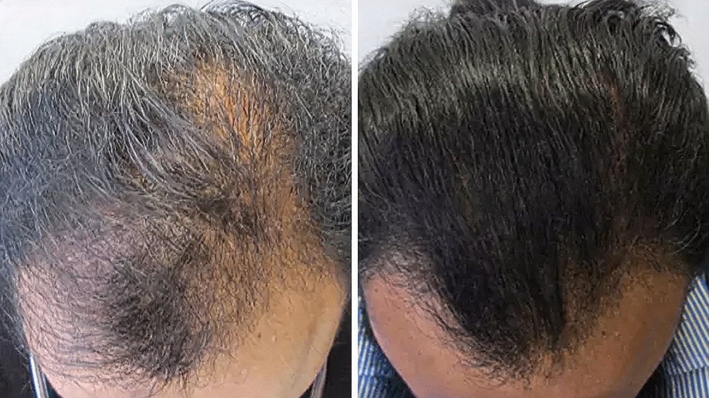 Before and after hair-loss progress for Robert J